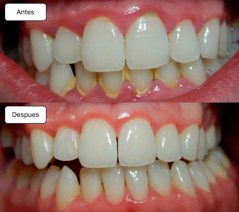 Limpiador De Dientes Quita Sarro Raspado